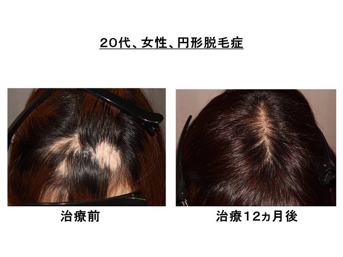 円形脱毛症　名医""